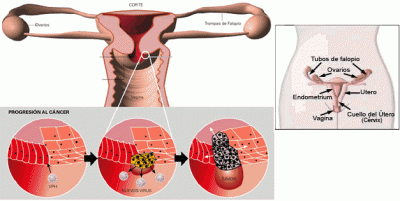 20081106210734-hpv-not01-im01.gif