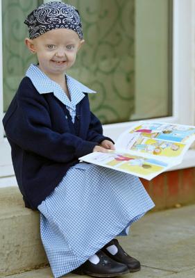 20081120191218-20081111190306-nina-kon-progeria.jpg