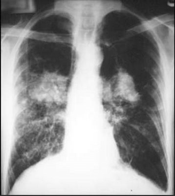 fibrosis